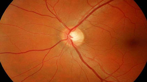 La retinopatía hipertensiva incrementa el riesgo de reingreso en pacientes coronarios