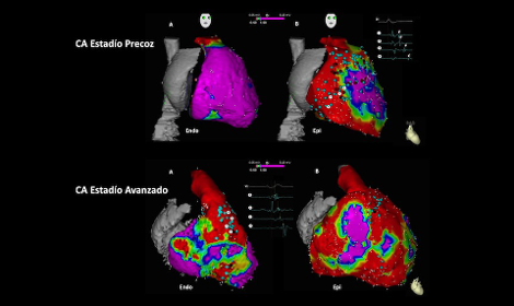 Ablación de Sustrato Endo-Epicárdico en Cardiopatía Arritmogénica