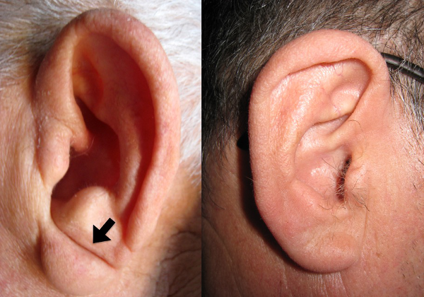 Tener un pliegue diagonal en el lóbulo de la oreja es un marcador de  enfermedad cardiovascular - Sociedad Española de Cardiología